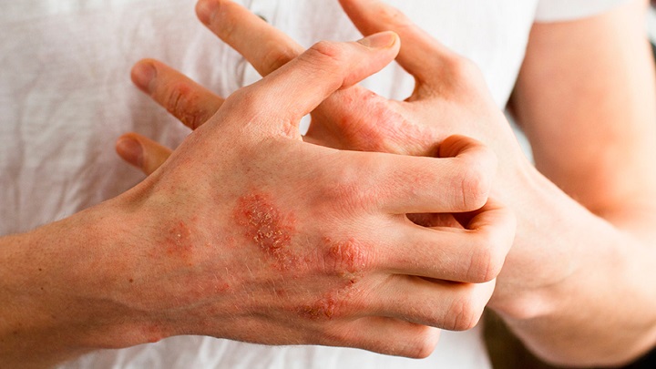 La dermatitis afecta a cualquier persona