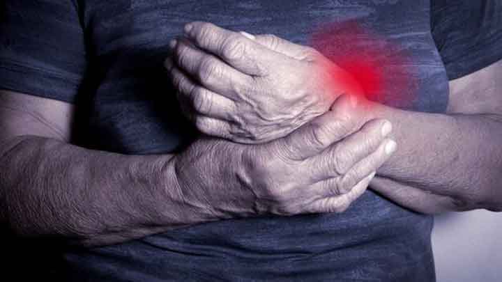  La Artritis Reumatoide no tratada conlleva a deformidades y dificultad para la movilización. / Foto: Colprensa