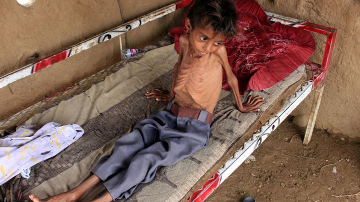 Cientos de niños padecen desnutrición en Yemen.  La guerra civil de 7 años entre las fuerzas progubernamentales y los rebeldes huzíes ha llevado al país al borde de la hambruna./Foto: AFP