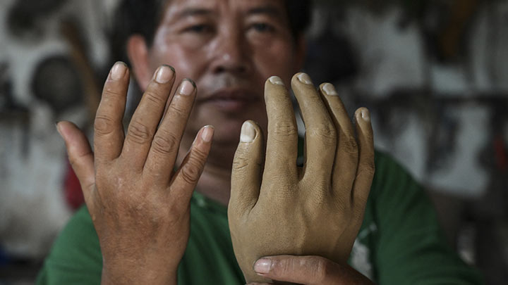 En Indonesia, piernas nuevas para recuperarse de la lepra./Foto: AFP