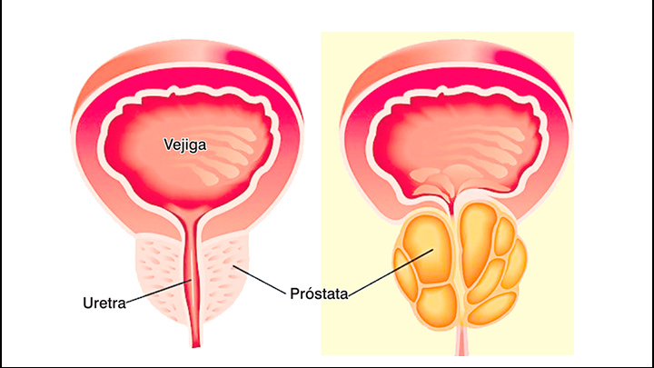 Alimentos buenos para la prostata