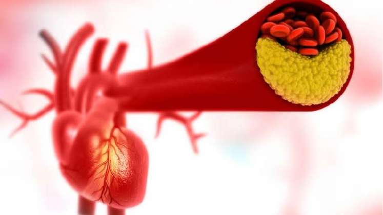 Arterosclerosis, enemigo de cuidado para tus arterias