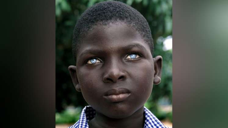 Albinismo ocular: una afección heredada en los ojos./Foto: tomadas de https://superatuenfermedad.com/