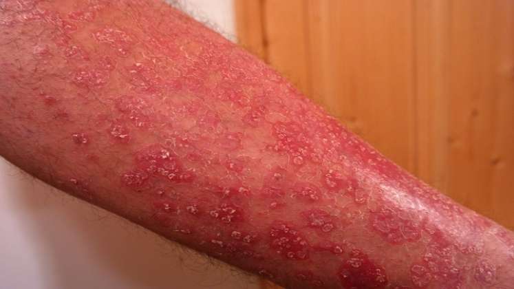 El 14 de septiembre es el Día Mundial de la Dermatitis Atópica. / Cortesía 