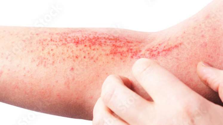 La dermatitis atópica, en su condición de enfermedad crónica, compromete la piel de las personas afectadas durante toda su vida. / Foto: Freepik