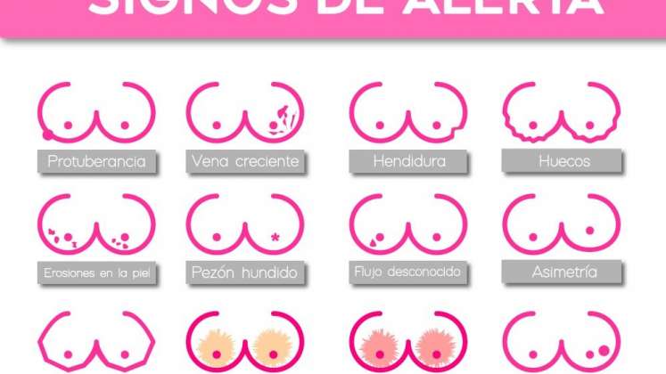 Síntomas del cáncer de mama. / Foto: Cortesía/ La Opinión 