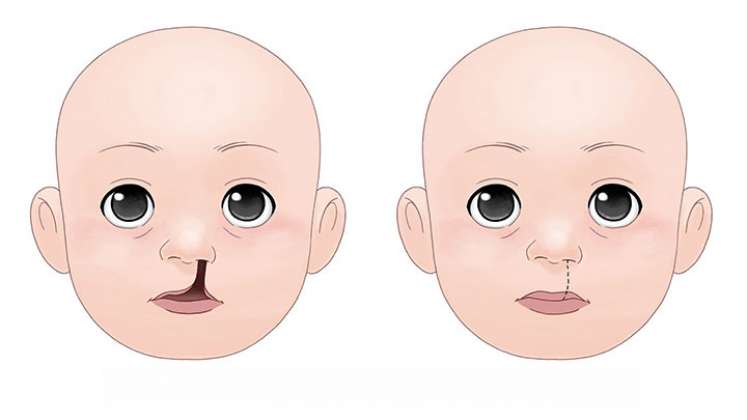 Cómo mejorar la calidad de vida de los niños con labio y paladar hendido